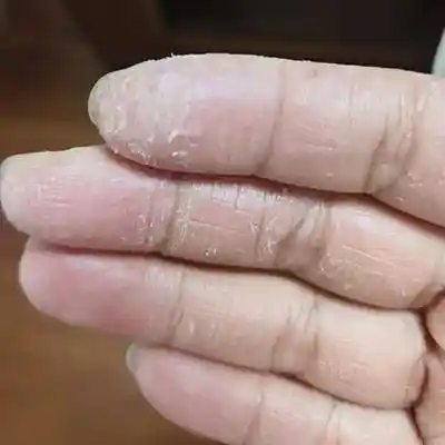 手部变粗糙，可能是这种疾病作祟，警惕！