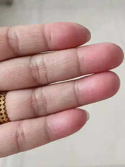 手部变粗糙，可能是这种疾病作祟，警惕！