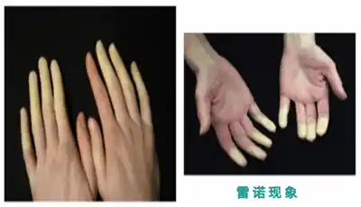 手部变粗糙，可能是这种疾病作祟，警惕！