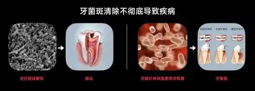 欧可林AirPump A10氧气啵啵冲牙器引领口腔护理新潮流